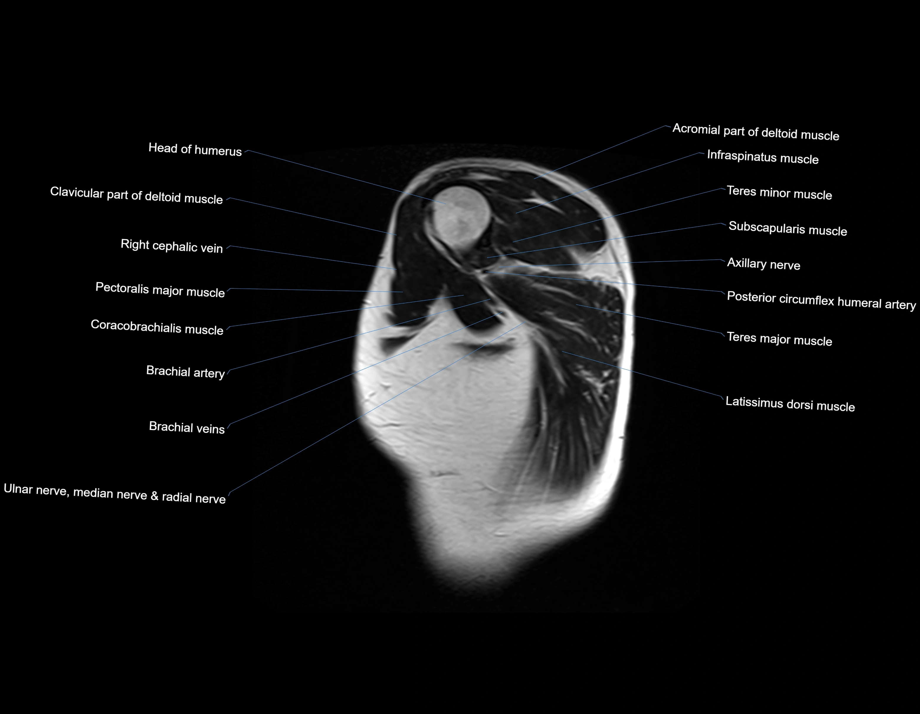 MRI chest (thorax) sagittal labelled cross sectional anatomy 3T radiology image-img-00001-00001.webp